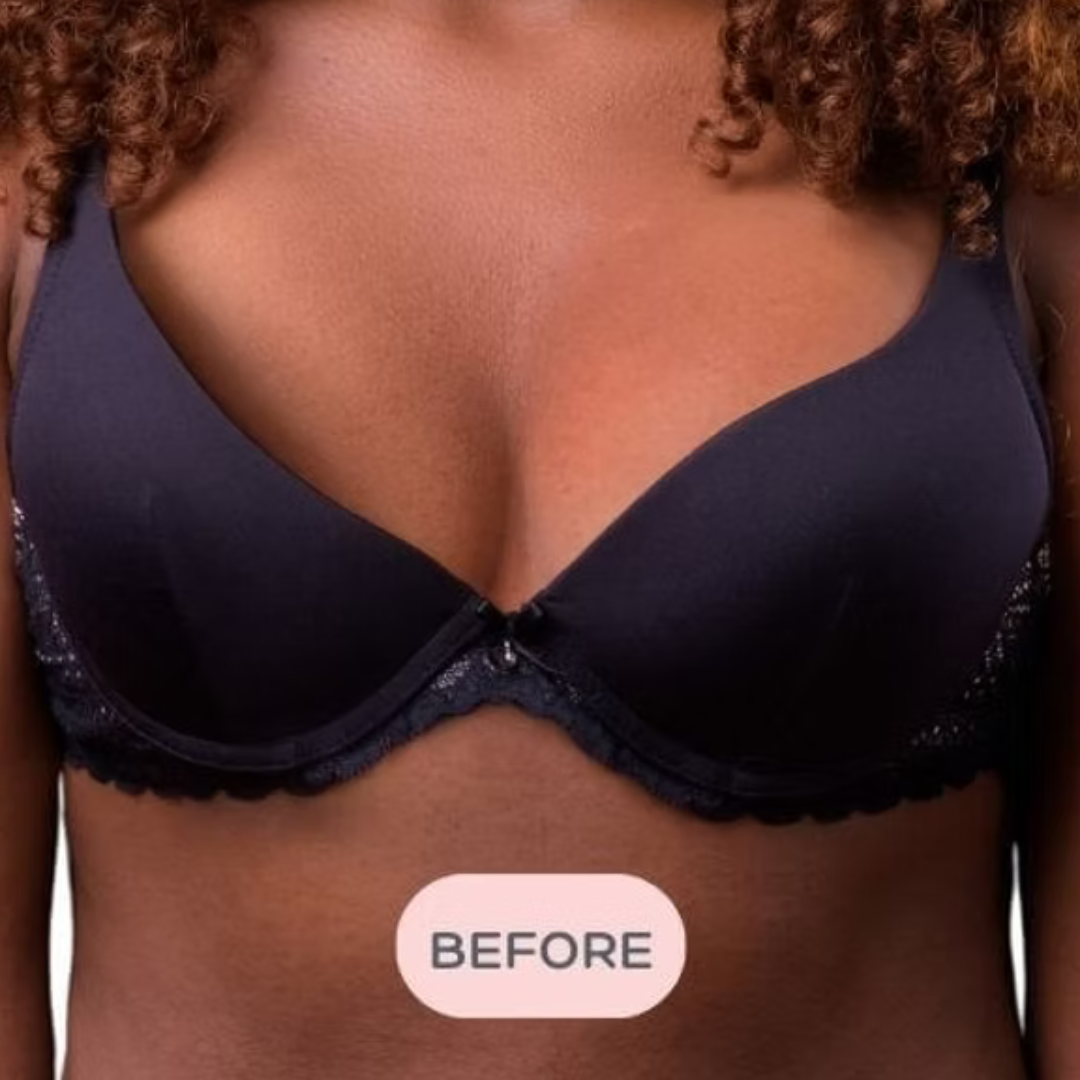 image showing bra before using the bra balancer for breast asymmetry